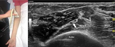 Ultrasound in the Evaluation of Radial Neuropathies at the Elbow